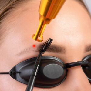 Tattoo Laser Removal